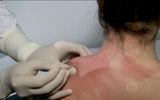 Tratamento com agulhas pode aliviar dores musculares nas costas